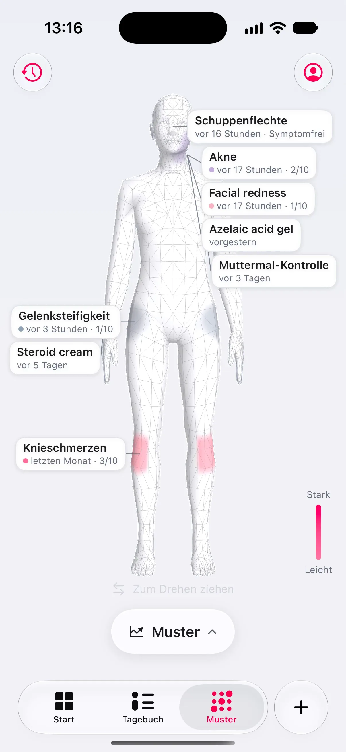Der Körperatlas von Longnote: eine 3-D-Figur mit eingefärbten Hüften und beiden Knien und datierten Beschriftungen: Schuppenflechte vor 16 Stunden, symptomfrei; Akne vor 17 Stunden, 2 von 10; „Facial redness“ vor 17 Stunden, 1 von 10; „Azelaic acid gel“ vorgestern; Muttermal-Kontrolle vor 3 Tagen; Gelenksteifigkeit vor 3 Stunden, 1 von 10; „Steroid cream“ vor 5 Tagen; Knieschmerzen letzten Monat, 3 von 10; daneben eine Skala von leicht bis stark.