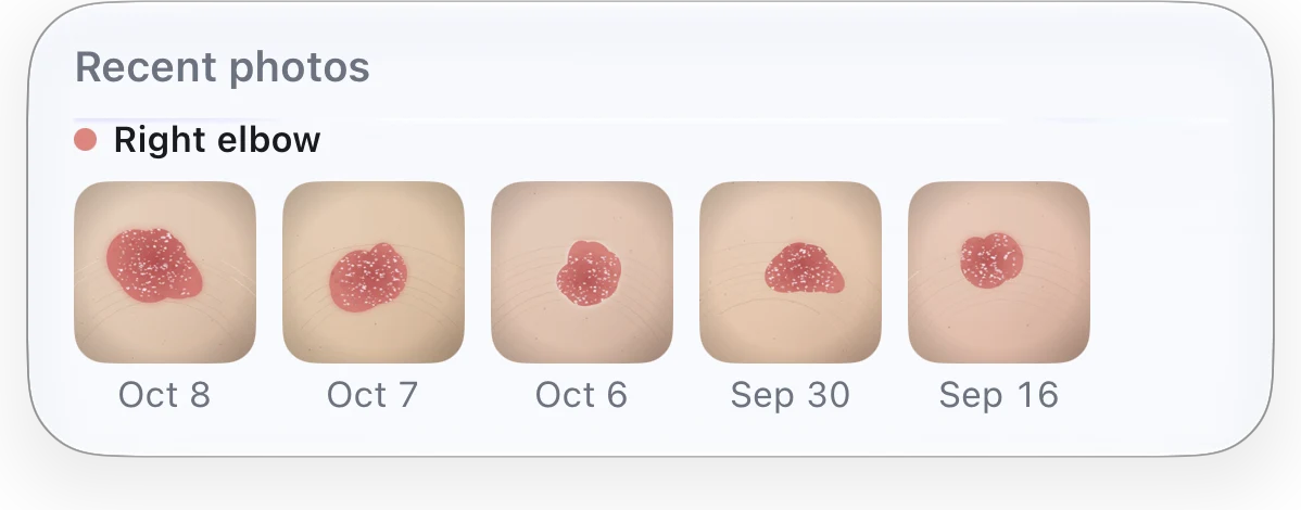 The body atlas’s Recent photos panel: under the heading, the right elbow’s five newest photos of a skin patch, dated Oct 8, Oct 7, Oct 6, Sep 30 and Sep 16.