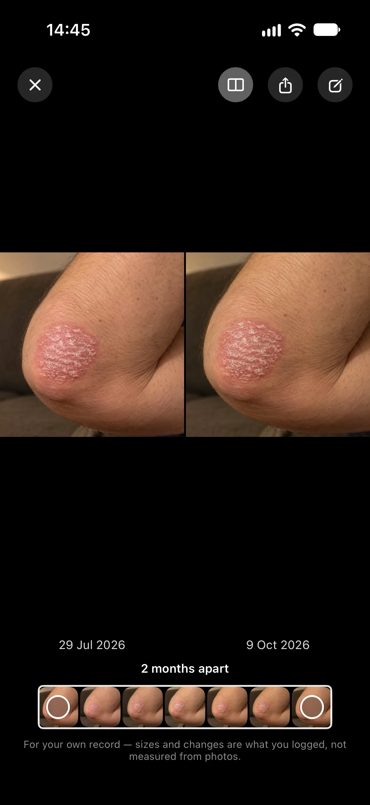 Compare in Longnote’s photo viewer: the same psoriasis patch on 29 July and on 9 October 2026, side by side, captioned 2 months apart.